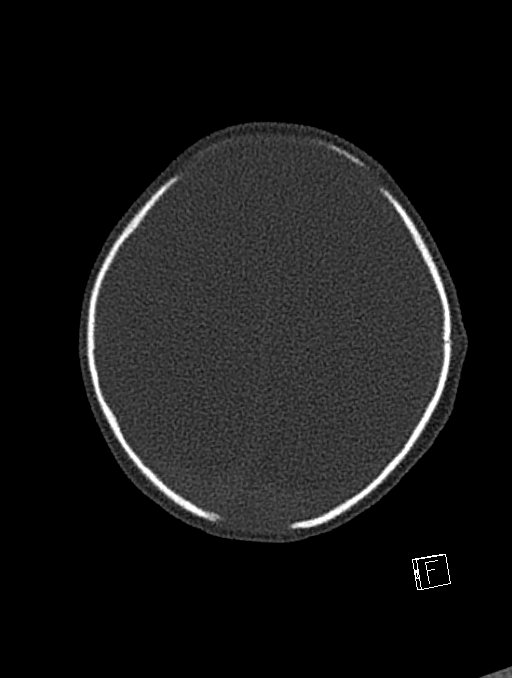 Bilateral subdural hemorrhage and parietal skull fracture (Radiopaedia 26058-26192 Axial bone window 26).png