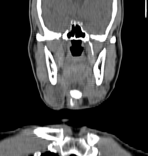 File:Bilateral submandibular sialolithiasis with sialadenitis (Radiopaedia 70721-80881 Coronal non-contrast 28).jpg