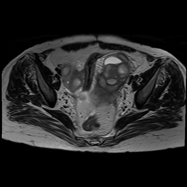 Bilateral tubo-ovarian abscesses (Radiopaedia 58635-65829 Axial T2 22).jpg