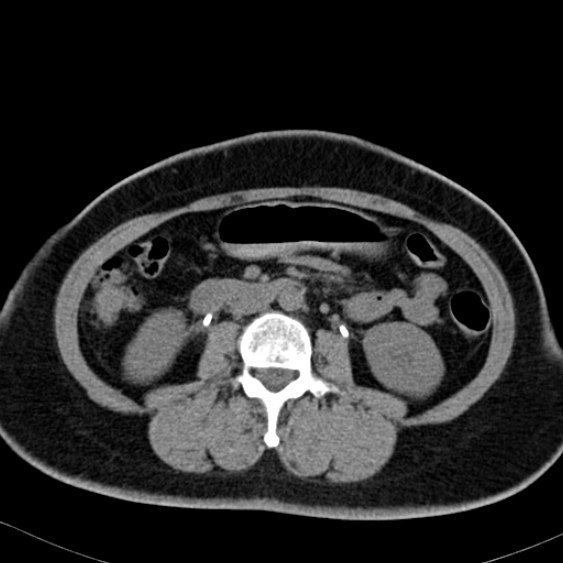 Bilateral ureteric stents (Radiopaedia 48795-53825 Axial non-contrast 29).jpg