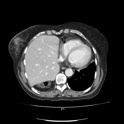 File:Bladder tumor detected on trauma CT (Radiopaedia 51809-57609 B 18).jpg