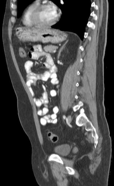 Bleeding duodenal ulcer and adenomyomatosis of gallbladder (Radiopaedia 61834-69861 C 62).jpg