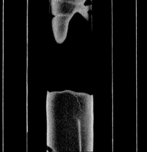 File:Blind-ending branch of a bifid ureter (Radiopaedia 61159-69048 F 73).jpg