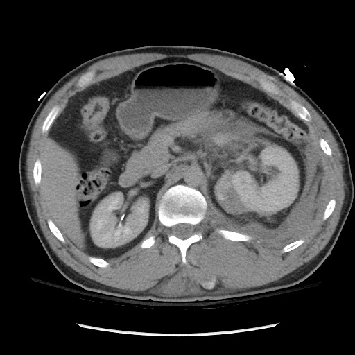Blunt abdominal trauma with solid organ and musculoskelatal injury with active extravasation (Radiopaedia 68364-77895 Axial C+ delayed 49).jpg