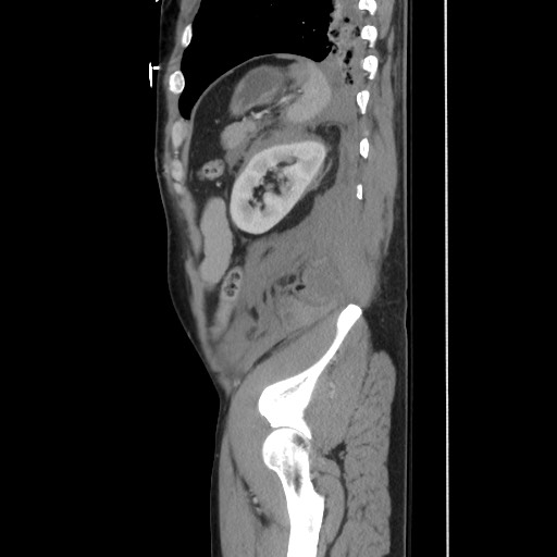 File:Blunt abdominal trauma with solid organ and musculoskelatal injury with active extravasation (Radiopaedia 68364-77895 C 113).jpg
