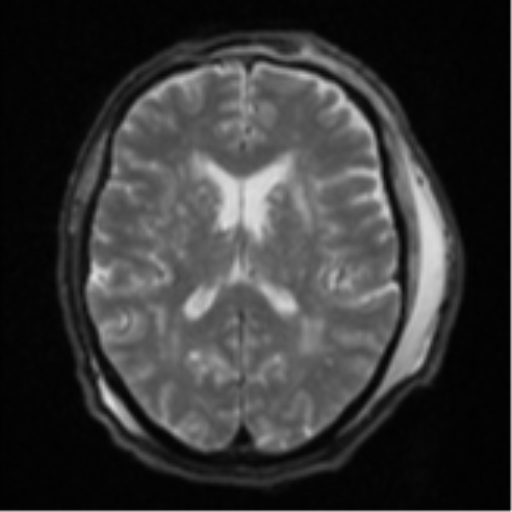 Blunt cerebrovascular injury (Radiopaedia 53682-59745 Axial DWI 18).png