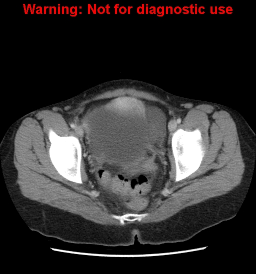 Borderline mucinous cystadenoma of ovary (Radiopaedia 25586-25767 A 104).jpg