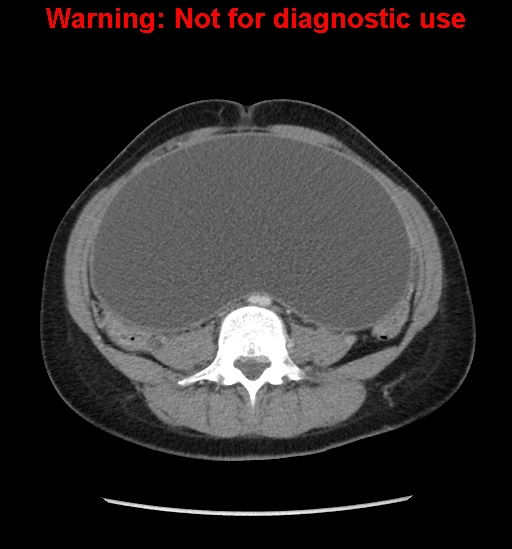 Borderline mucinous cystadenoma of ovary (Radiopaedia 25586-25767 A 46).jpg