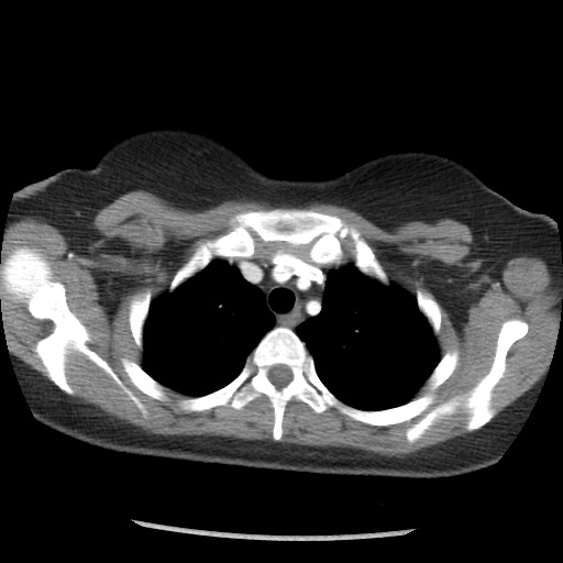 Borderline mucinous tumor (ovary) (Radiopaedia 78228-90808 A 11).jpg