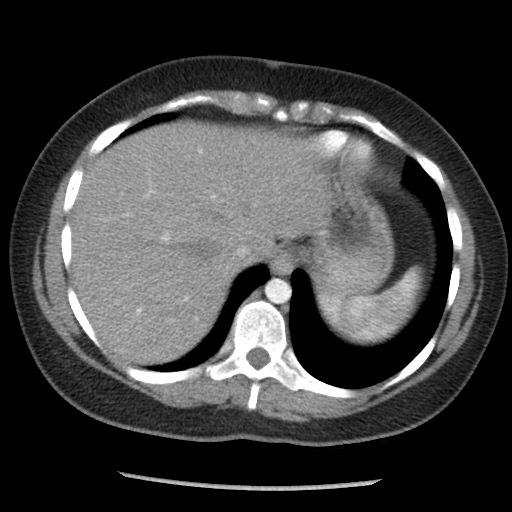 Borderline mucinous tumor (ovary) (Radiopaedia 78228-90808 A 38).jpg