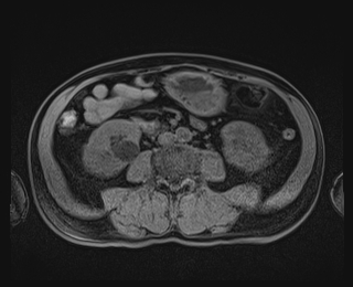 Bouveret syndrome (Radiopaedia 61017-68856 Axial T1 fat sat 55).jpg