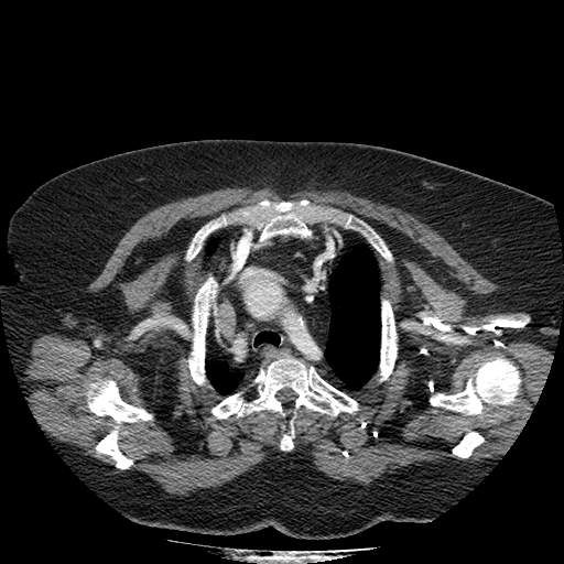 Bovine aortic arch - right internal mammary vein drains into the superior vena cava (Radiopaedia 63296-71875 A 24).jpg