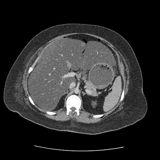 File:Bowel and splenic infarcts in acute lymphocytic leukemia (Radiopaedia 61055-68915 A 47).jpg
