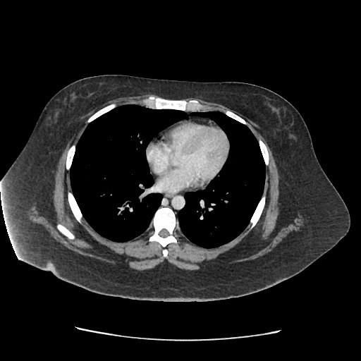 Bowel and splenic infarcts in acute lymphocytic leukemia (Radiopaedia 61055-68915 A 8).jpg