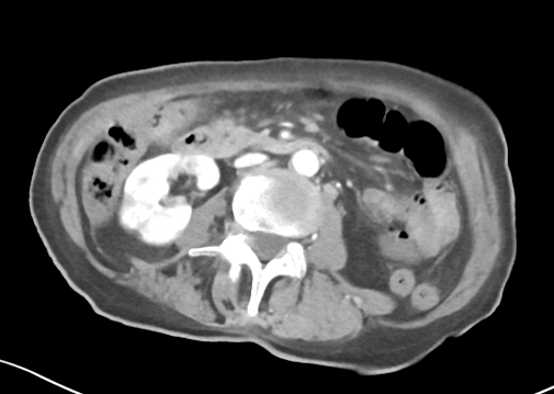 File:Bowel ischemia (Radiopaedia 58273-65382 A 28).png
