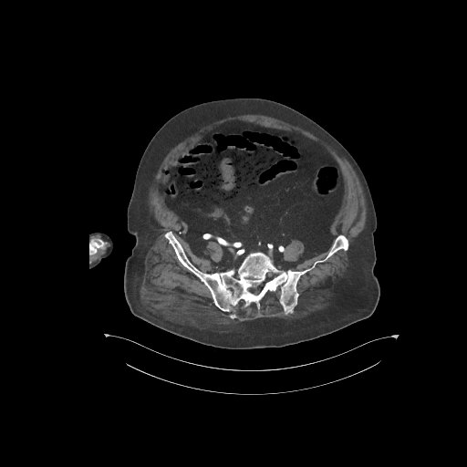 File:Bowel ischemia secondary to SMA occlusion with extensive portomesenteric venous gas (Radiopaedia 54656-60871 A 13).jpg