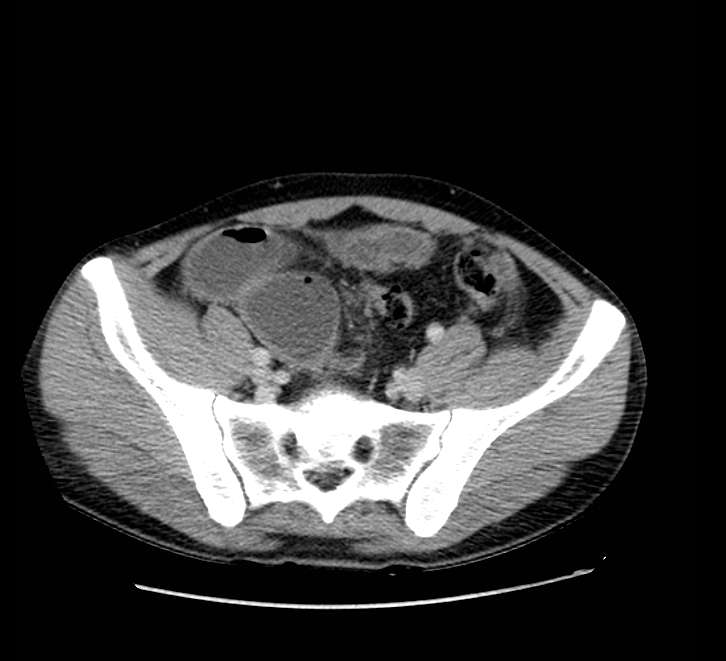 Bowel obstruction from colon carcinoma (Radiopaedia 22995-23028 A 66).jpg