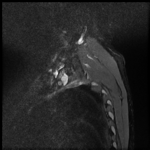 File:Brachial plexus neurofibroma (Radiopaedia 28030-28291 Sagittal STIR 11).png
