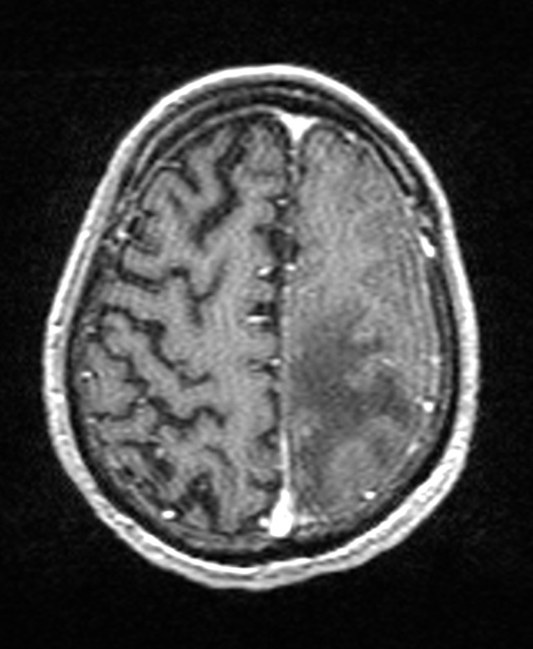 Brain abscess with dual rim sign (Radiopaedia 87566-103938 Axial T1 C+ 128).jpg