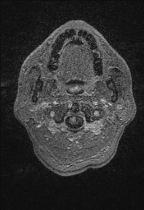 Brain abscess with ventriculitis (Radiopaedia 85703-101495 Axial T1 C+ 2).jpg