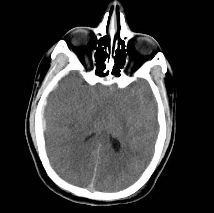 File:Brain death after motor vehicle collision (Radiopaedia 88470-105114 Axial 1).png