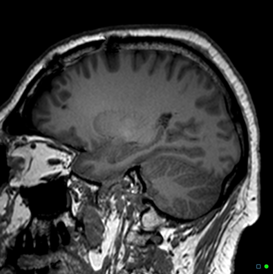 Brain death on MRI and CT angiography (Radiopaedia 42560-45689 Sagittal T1 50).jpg