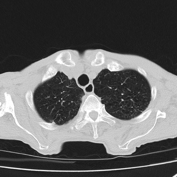 Brain metastases from lung cancer (Radiopaedia 27849-28093 Axial lung window 11).jpg