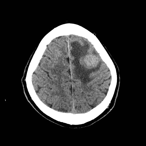 File:Brain metastases from lung cancer (Radiopaedia 83839-99027 Axial non-contrast 29).jpg