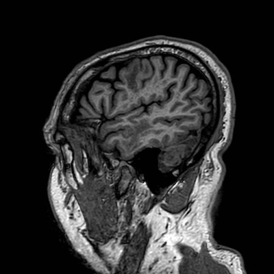 Brain metastases from lung cancer (Radiopaedia 83839-99028 Sagittal T1 110).jpg