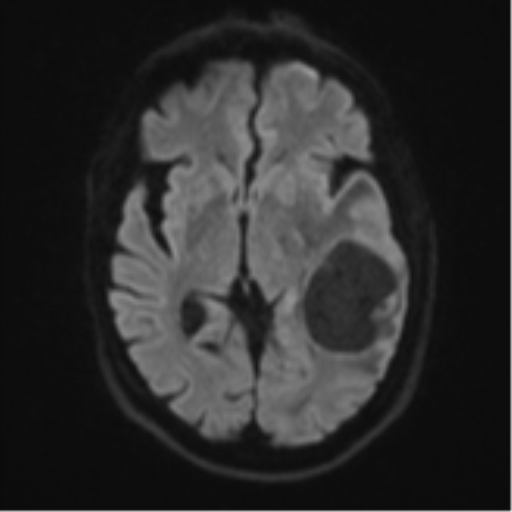 Brain metastasis (large cystic mass) (Radiopaedia 47497-52107 Axial DWI 41).png