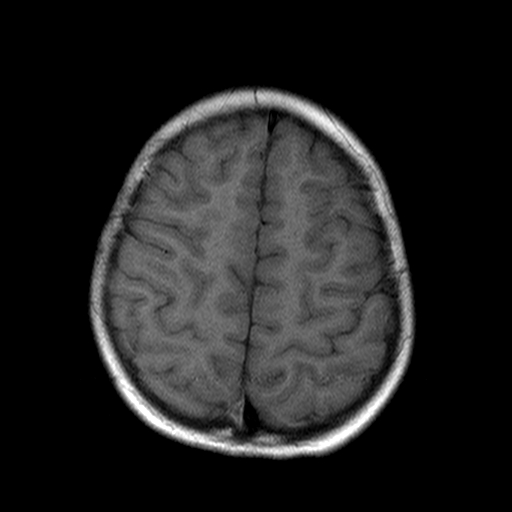 File:Brainstem ganglioglioma (Radiopaedia 10763-11224 Axial T1 4).jpg