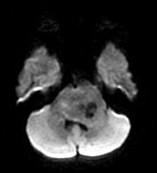 File:Brainstem glioma (Radiopaedia 9444-10124 Axial DWI 1).jpg