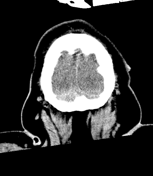 Brainstem hemorrhage (Radiopaedia 81294-94976 Coronal non-contrast 63).jpg