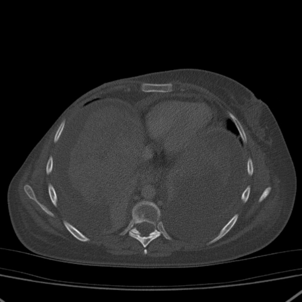 Breast cancer metastases - hepatic and skeletal (Radiopaedia 34201-35461 Axial bone window 27).jpg