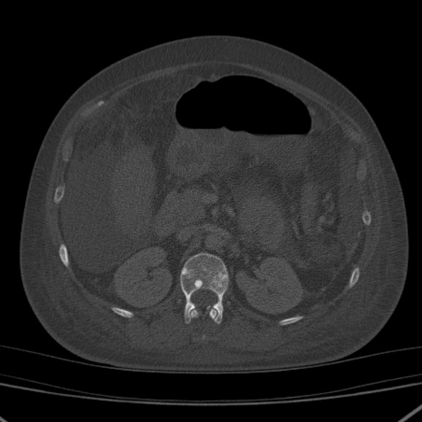 Breast cancer metastases - hepatic and skeletal (Radiopaedia 34201-35461 Axial bone window 53).jpg