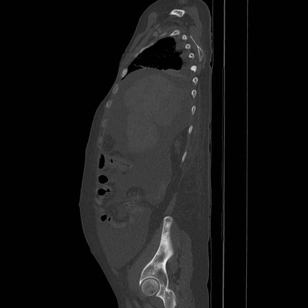 Breast cancer metastases - hepatic and skeletal (Radiopaedia 34201-35461 Sagittal bone window 26).jpg