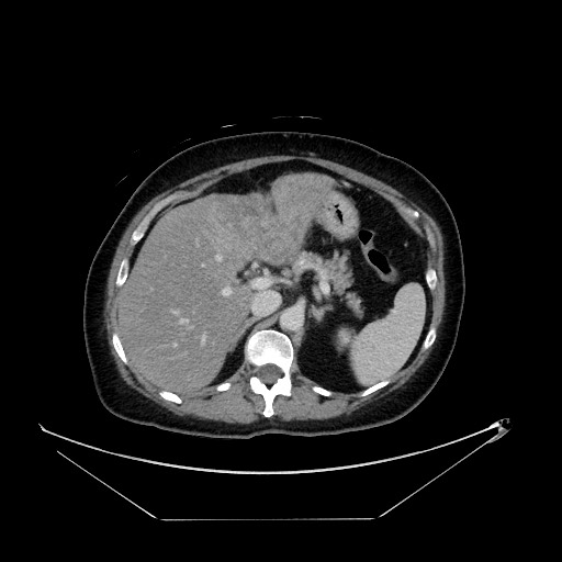File:Breast cancer pseudocirrhosis with lobar invovlement (Radiopaedia 81080-94670 A 52).jpg