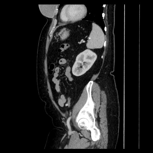 Breast cancer pseudocirrhosis with lobar invovlement (Radiopaedia 81080-94670 D 157).jpg