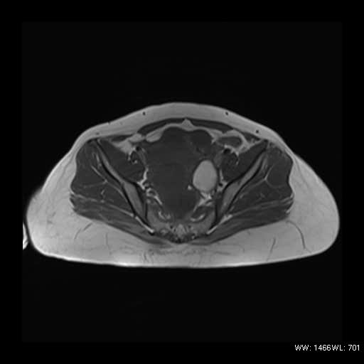 File:Broad ligament fibroid (Radiopaedia 49135-54241 Axial T1 9).jpg