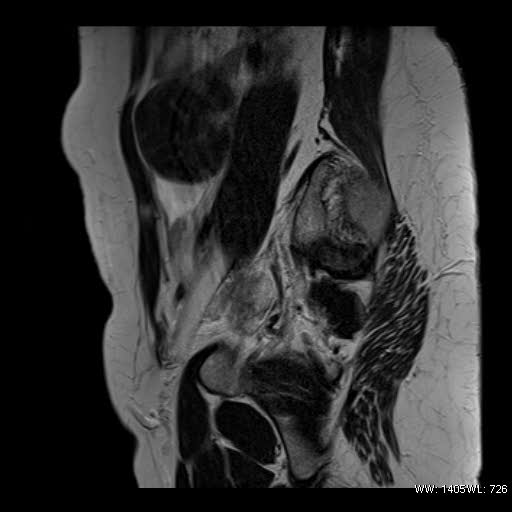 File:Broad ligament fibroid (Radiopaedia 49135-54241 Sagittal T2 5).jpg