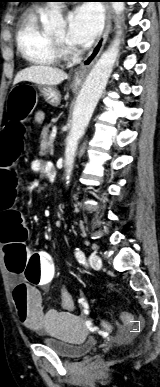 Broad ligament hernia (Radiopaedia 84802-100276 C 32).jpg
