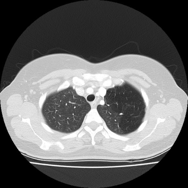 Bronchial atresia (Radiopaedia 22965-22992 Axial lung window 42).jpg