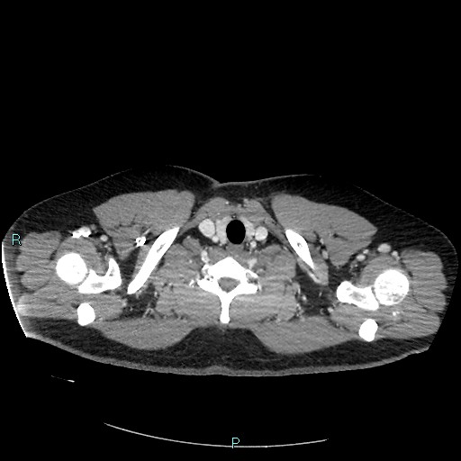Bronchial carcinoid tumor (Radiopaedia 78272-90875 A 10).jpg