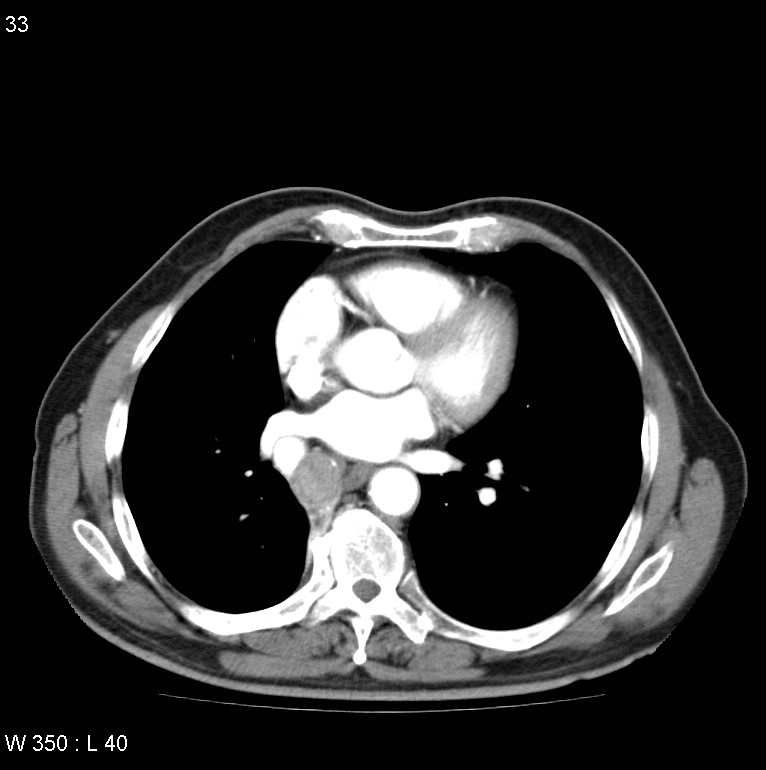 Bronchial carcinoid tumor with right lower lobe collapse (Radiopaedia 29060-29422 A 32).jpg