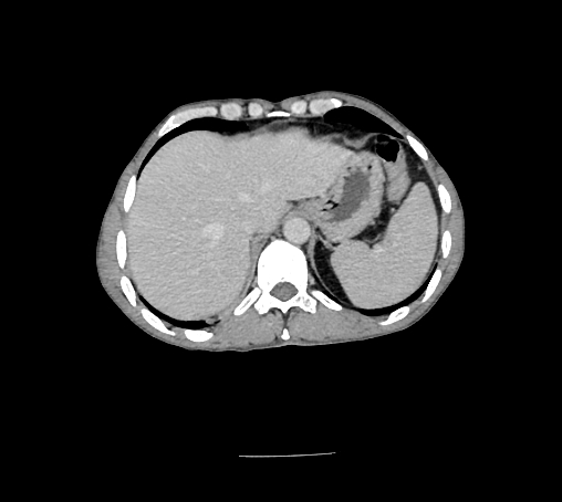 File:Bronchiectasis in Crohn disease (Radiopaedia 60311-67977 B 27).jpg
