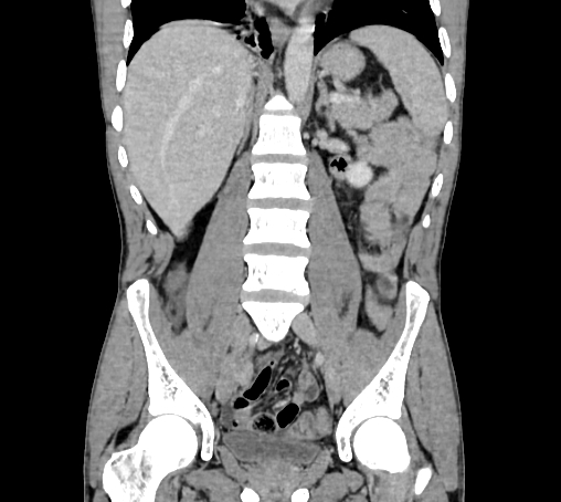 Bronchiectasis in Crohn disease (Radiopaedia 60311-67977 C 46).jpg