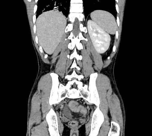 Bronchiectasis in Crohn disease (Radiopaedia 60311-67977 C 65).jpg