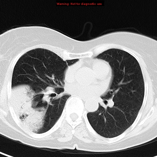 File:Bronchoalveolar carcinoma (BAC) (Radiopaedia 13436-13392 Axial lung window 28).jpg