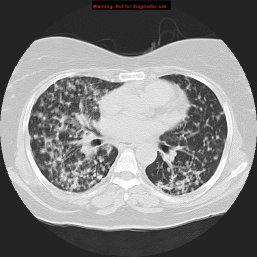 Bronchoalveolar carcinoma (Radiopaedia 13224-13233 Axial lung window 25).jpg