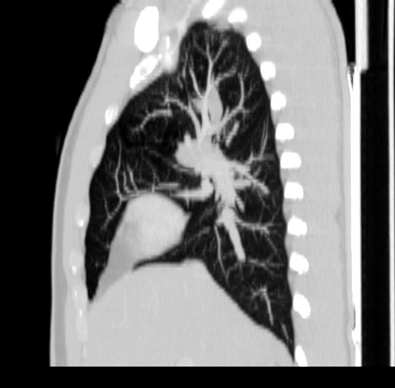 File:Bronchocele (Radiopaedia 12104-12460 Sagittal lung window 3).jpg